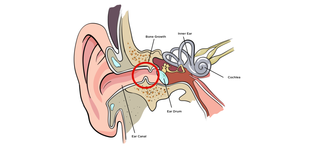 surfer's ear